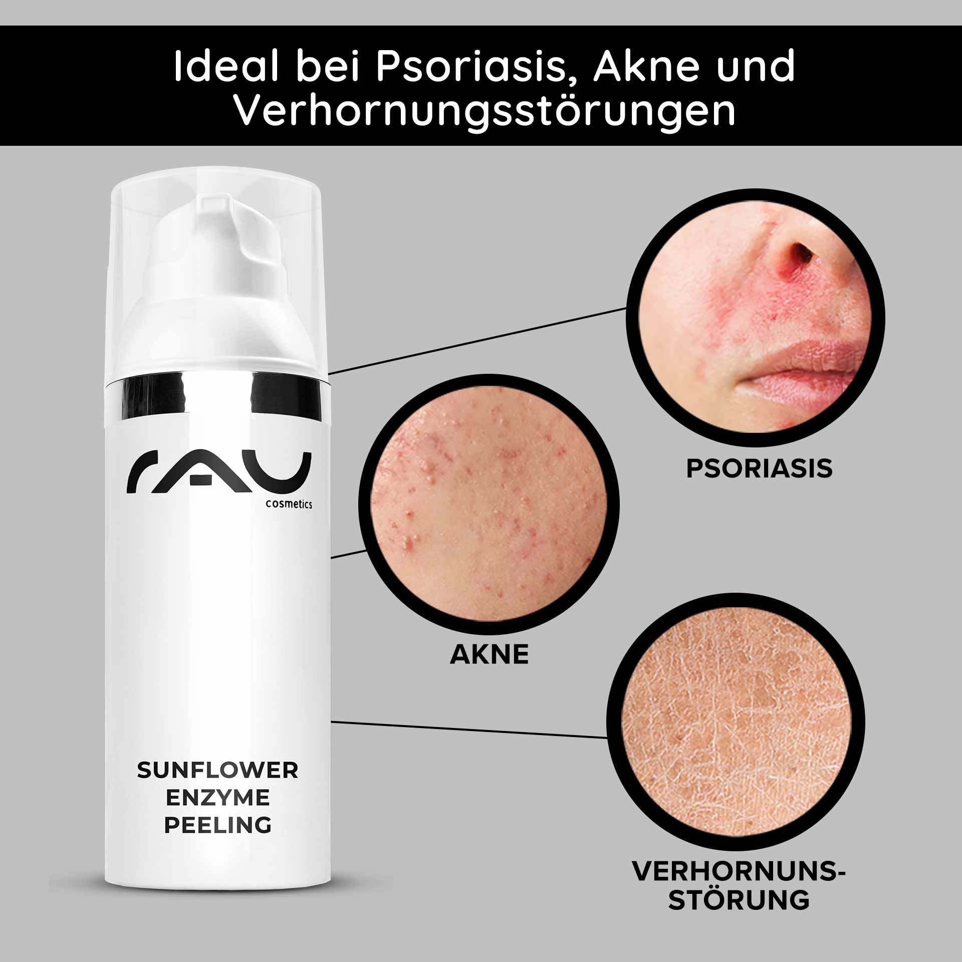 Verpackung des Sunflower Enzyme Peeling von RAU Cosmetics mit hervorgehobenen Hautproblemen: Schuppenflechte, Akne und Hyperkeratose.