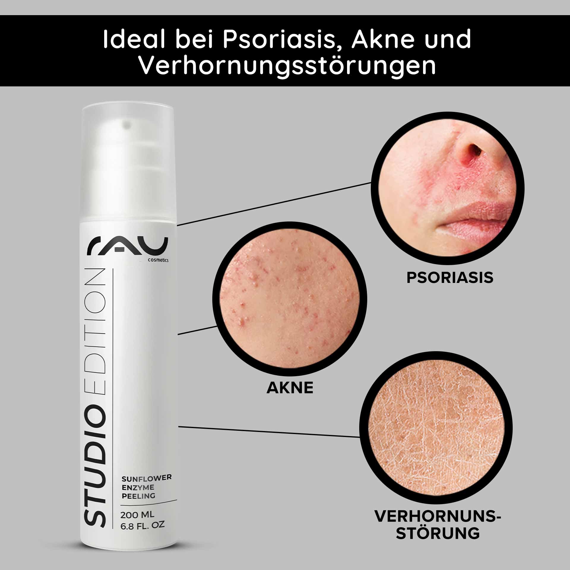 Verpackung des RAU Sunflower Enzyme Peeling mit hervorgehobenen Vorteilen bei Schuppenflechte, Akne und Keratose; Nahaufnahmen von Hautzuständen veranschaulichen die Wirksamkeit.