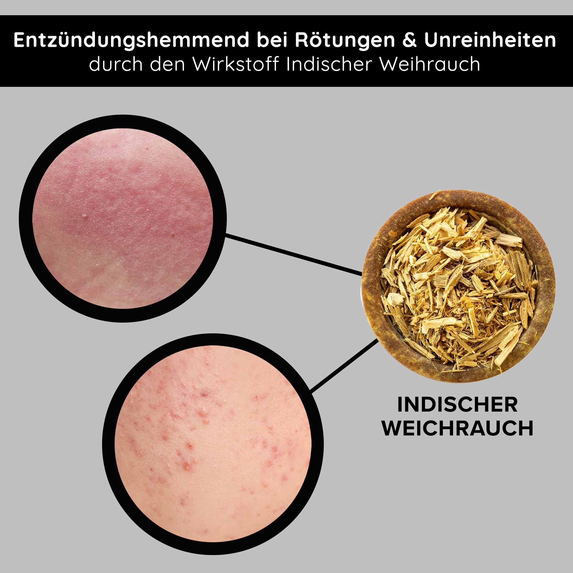 Encens indien anti-inflammatoire pour réduire les rougeurs et les imperfections, avec des gros plans de la peau concernée.
