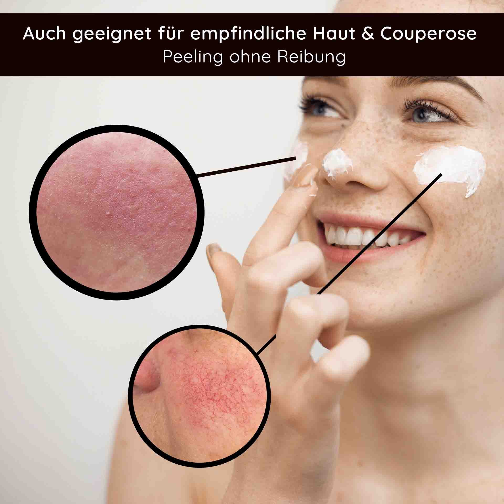 Frau mit freudigem Lächeln, die ein Fruchtsäurepeeling auf das Gesicht aufträgt, mit Nahaufnahmen von empfindlicher Haut und Rötungen, geeignet für empfindliche Haut und Couperose, Peeling ohne Reibung.