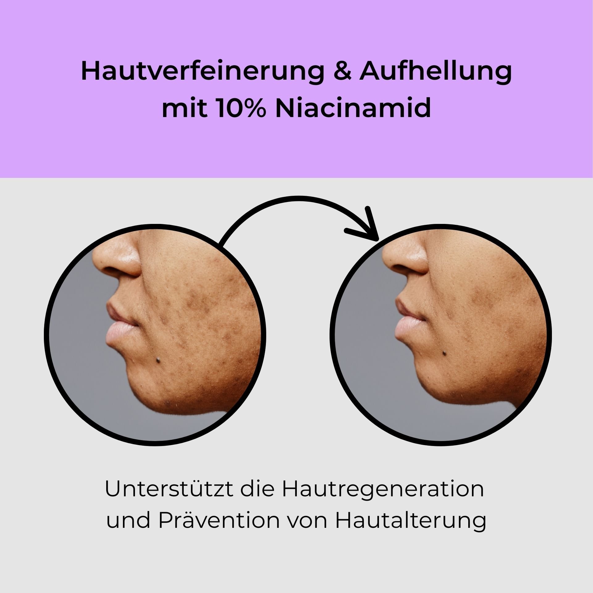 Hautverfeinerung und Aufhellung mit 10% Niacinamid, Vorher-Nachher-Bilder der Hauttextur, Unterstützung der Hautregeneration und Prävention von Hautalterung.