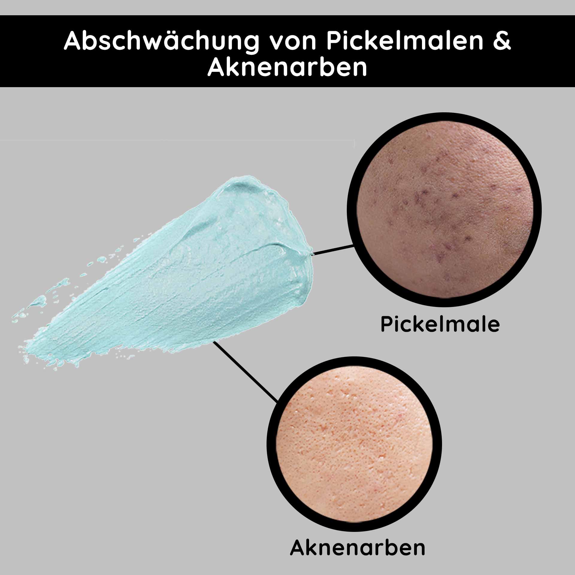 Atténuation des marques de boutons et des cicatrices d'acné avec une crème bleue, comparaison des textures de peau pour les produits de soin.