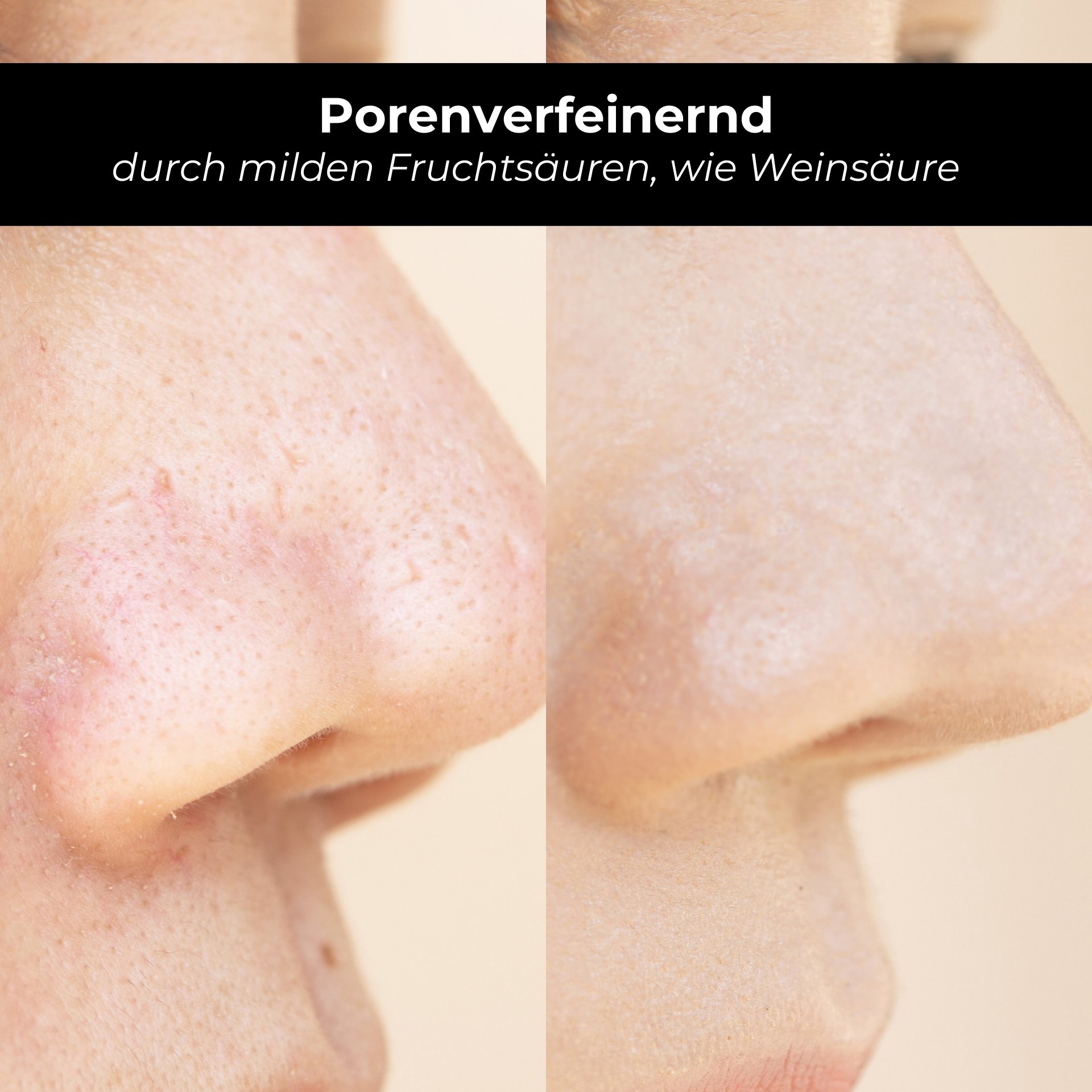 Pores affinés : Comparaison avant/après de l'aspect de la peau après l'utilisation d'acide tartrique et d'acides de fruits.