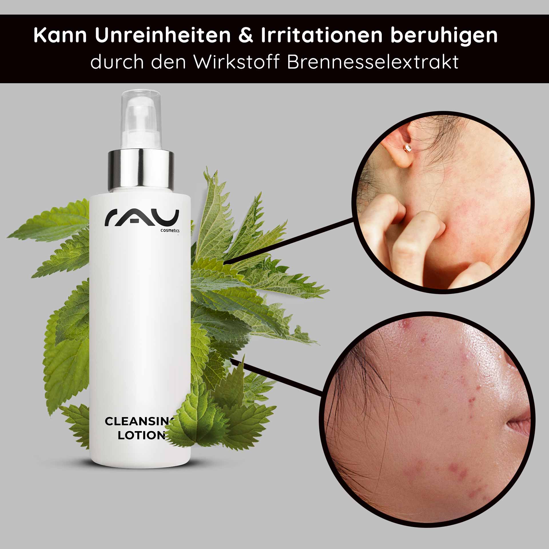Cleansing Lotion 200 ml - lotion nettoyante en profondeur Flasche der RAU-Reinigungslotion mit Brennnesselblättern im Hintergrund, die die Vorteile bei der Linderung von Unreinheiten und Reizungen hervorhebt und Nahaufnahmen von Haut mit Unreinheiten zeigt.